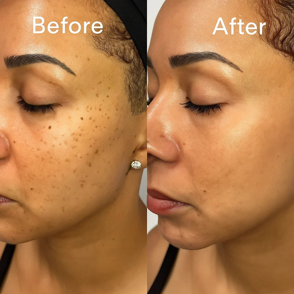 LaserTouch™ Mole and Wart Remover | Visible results within 72 hours