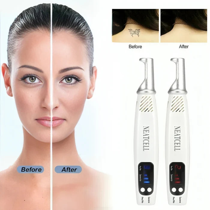 Laser Tattoo Removal Pen - Fade ink by 40% in 3 sessions