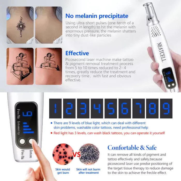 Laser Tattoo Removal Pen - Fade ink by 40% in 3 sessions