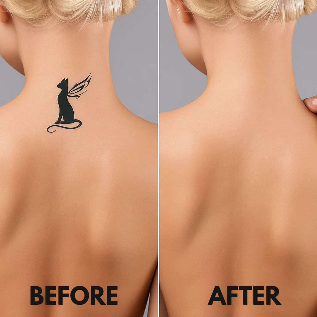 Laser Tattoo Removal Pen - Fade ink by 40% in 3 sessions